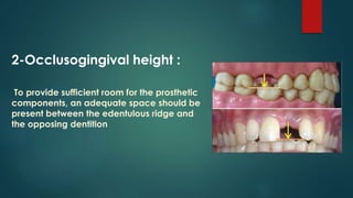 Sufficient Ridges Comprehensive Guide to Pontic Design and Classification in ...