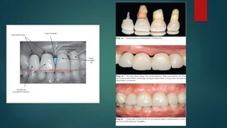 Comprehensive Guide to Pontic Design and Classification in ...