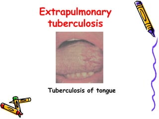 Extrapulmonary
tuberculosis
Tuberculosis of tongue
 