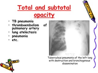 Total and subtotal
opacity
• TB pneumonia
• thromboembolism of
pulmonary artery
• lung atelectasis
• pneumonia
• etc.
Tuberculous pneumonia of the left lung
with destruction and bronchogenous
dissemination
 