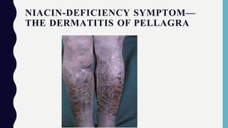 NIACIN-DEFICIENCY SYMPTOM—
THE DERMATITIS OF PELLAGRA
 