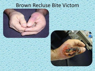 Brown Recluse Bite Victom
 