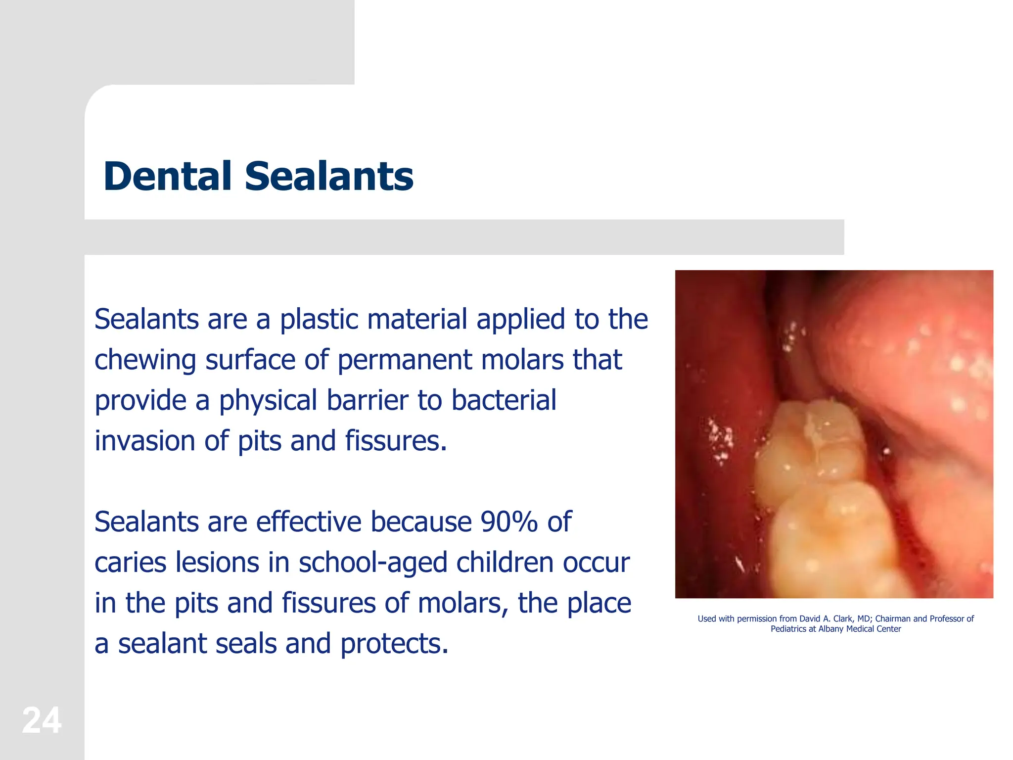 24
Dental Sealants
Sealants are a plastic material applied to the
chewing surface of permanent molars that
provide a physical barrier to bacterial
invasion of pits and fissures.
Sealants are effective because 90% of
caries lesions in school-aged children occur
in the pits and fissures of molars, the place
a sealant seals and protects.
Used with permission from David A. Clark, MD; Chairman and Professor of
Pediatrics at Albany Medical Center
 
