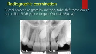 Lec 2 principles of management of impacted teeth | PPT