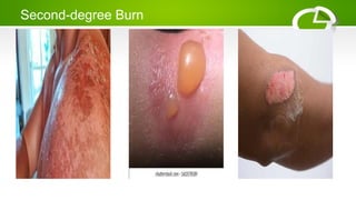 Second-degree Burn
 