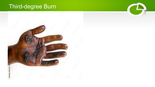 Third-degree Burn
 