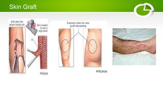 Skin Graft
 