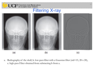 Filtering X-ray
58
a. Radiography of the skull, b. low-pass filter with a Gaussian filter (std=15, 20 x 20),
c. high-pass Filter obtained from subtracting b from a.
 