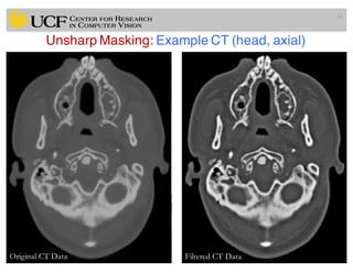 Unsharp Masking: Example CT (head, axial)
64
Original CT Data Filtered CT Data
 