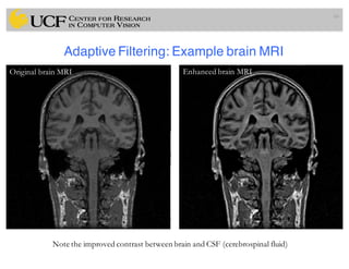 Adaptive Filtering: Example brain MRI
66
Original brain MRI Enhanced brain MRI
Note the improved contrast between brain and CSF (cerebrospinal fluid)
 