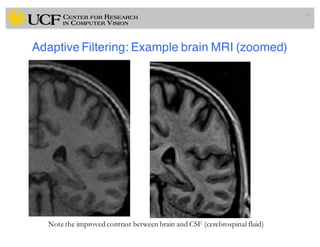 Adaptive Filtering: Example brain MRI (zoomed)
67
Enhanced brain MRI
Note the improved contrast between brain and CSF (cerebrospinal fluid)
 
