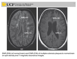 76
SNR (S/N) (of normal brain) and CNR (C/N) of multiple sclerosis plaques to normal brain
on spin-density and T1 magnetic resonance images.
 