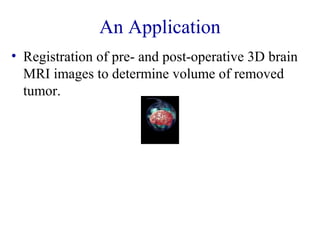 An Application 
• Registration of pre- and post-operative 3D brain 
MRI images to determine volume of removed 
tumor. 
 