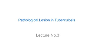 Pathological Lesion in Tuberculosis
Lecture No.3
 