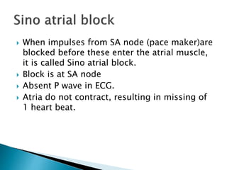  When impulses from SA node (pace maker)are
blocked before these enter the atrial muscle,
it is called Sino atrial block.
 Block is at SA node
 Absent P wave in ECG.
 Atria do not contract, resulting in missing of
1 heart beat.
 