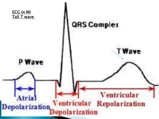 ECG in MI
Tall T wave
 