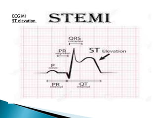 ECG MI
ST elevation
 