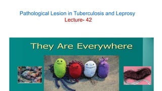 Pathological Lesion in Tuberculosis and Leprosy
Lecture- 42
 