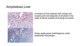 Amyloidosis Liver
A section of liver stained with Congo red
reveals pink-red deposits of amyloid in the
walls of blood vessels and along sinusoids
Gives apple-green birefringence under
polarizing microscope
 