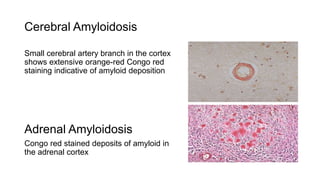 Cerebral Amyloidosis
Small cerebral artery branch in the cortex
shows extensive orange-red Congo red
staining indicative of amyloid deposition
Adrenal Amyloidosis
Congo red stained deposits of amyloid in
the adrenal cortex
 