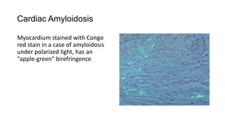 Cardiac Amyloidosis
Myocardium stained with Congo
red stain in a case of amyloidosis
under polarized light, has an
"apple-green" birefringence
 