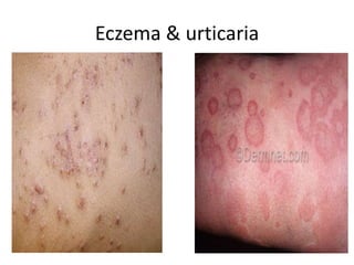 Eczema & urticaria
 