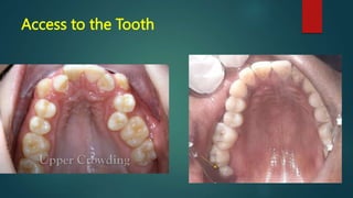 Access to the Tooth
 