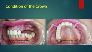 Condition of the Crown
Dr. Haydar Munir Salih Dr. Haydar Munir Salih
 