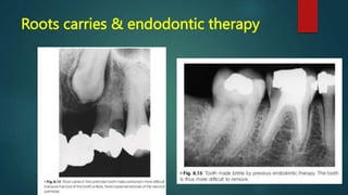 Roots carries & endodontic therapy
 