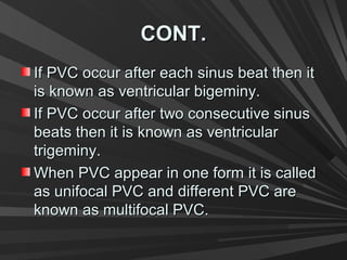 CONT.CONT.
If PVC occur after each sinus beat then itIf PVC occur after each sinus beat then it
is known as ventricular bigeminy.is known as ventricular bigeminy.
If PVC occur after two consecutive sinusIf PVC occur after two consecutive sinus
beats then it is known as ventricularbeats then it is known as ventricular
trigeminy.trigeminy.
When PVC appear in one form it is calledWhen PVC appear in one form it is called
as unifocal PVC and different PVC areas unifocal PVC and different PVC are
known as multifocal PVC.known as multifocal PVC.
 