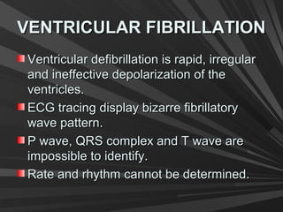 VENTRICULAR FIBRILLATIONVENTRICULAR FIBRILLATION
Ventricular defibrillation is rapid, irregularVentricular defibrillation is rapid, irregular
and ineffective depolarization of theand ineffective depolarization of the
ventricles.ventricles.
ECG tracing display bizarre fibrillatoryECG tracing display bizarre fibrillatory
wave pattern.wave pattern.
P wave, QRS complex and T wave areP wave, QRS complex and T wave are
impossible to identify.impossible to identify.
Rate and rhythm cannot be determined.Rate and rhythm cannot be determined.
 