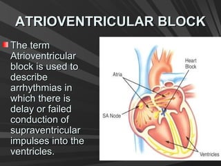 ATRIOVENTRICULAR BLOCKATRIOVENTRICULAR BLOCK
The termThe term
AtrioventricularAtrioventricular
block is used toblock is used to
describedescribe
arrhythmias inarrhythmias in
which there iswhich there is
delay or faileddelay or failed
conduction ofconduction of
supraventricularsupraventricular
impulses into theimpulses into the
ventricles.ventricles.
 