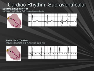 Cardiac Rhythm: SupraventricularCardiac Rhythm: Supraventricular
NORMAL SINUS RHYTHMNORMAL SINUS RHYTHM
Impuses originate at S-A node at normal rateImpuses originate at S-A node at normal rate
SINUS TACHYCARDIASINUS TACHYCARDIA
Impuses originate at S-A node at rapid rateImpuses originate at S-A node at rapid rate
 