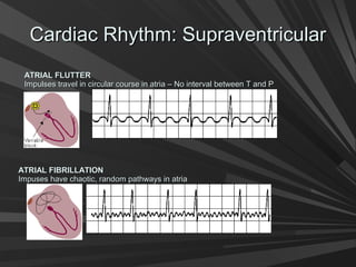 Cardiac Rhythm: SupraventricularCardiac Rhythm: Supraventricular
ATRIAL FLUTTERATRIAL FLUTTER
Impulses travel in circular course in atria – No interval between T and PImpulses travel in circular course in atria – No interval between T and P
ATRIAL FIBRILLATIONATRIAL FIBRILLATION
Impuses have chaotic, random pathways in atriaImpuses have chaotic, random pathways in atria
 