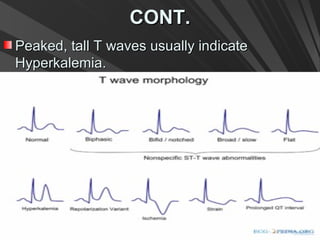 CONT.CONT.
Peaked, tall T waves usually indicatePeaked, tall T waves usually indicate
Hyperkalemia.Hyperkalemia.
 