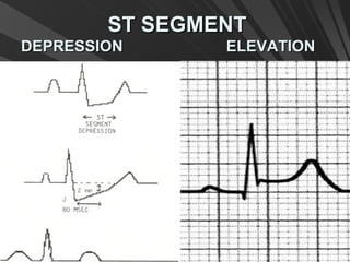 ST SEGMENTST SEGMENT
DEPRESSION ELEVATIONDEPRESSION ELEVATION
 