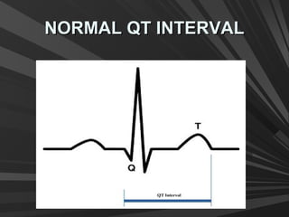 NORMAL QT INTERVALNORMAL QT INTERVAL
 