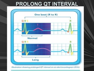 PROLONG QT INTERVALPROLONG QT INTERVAL
 