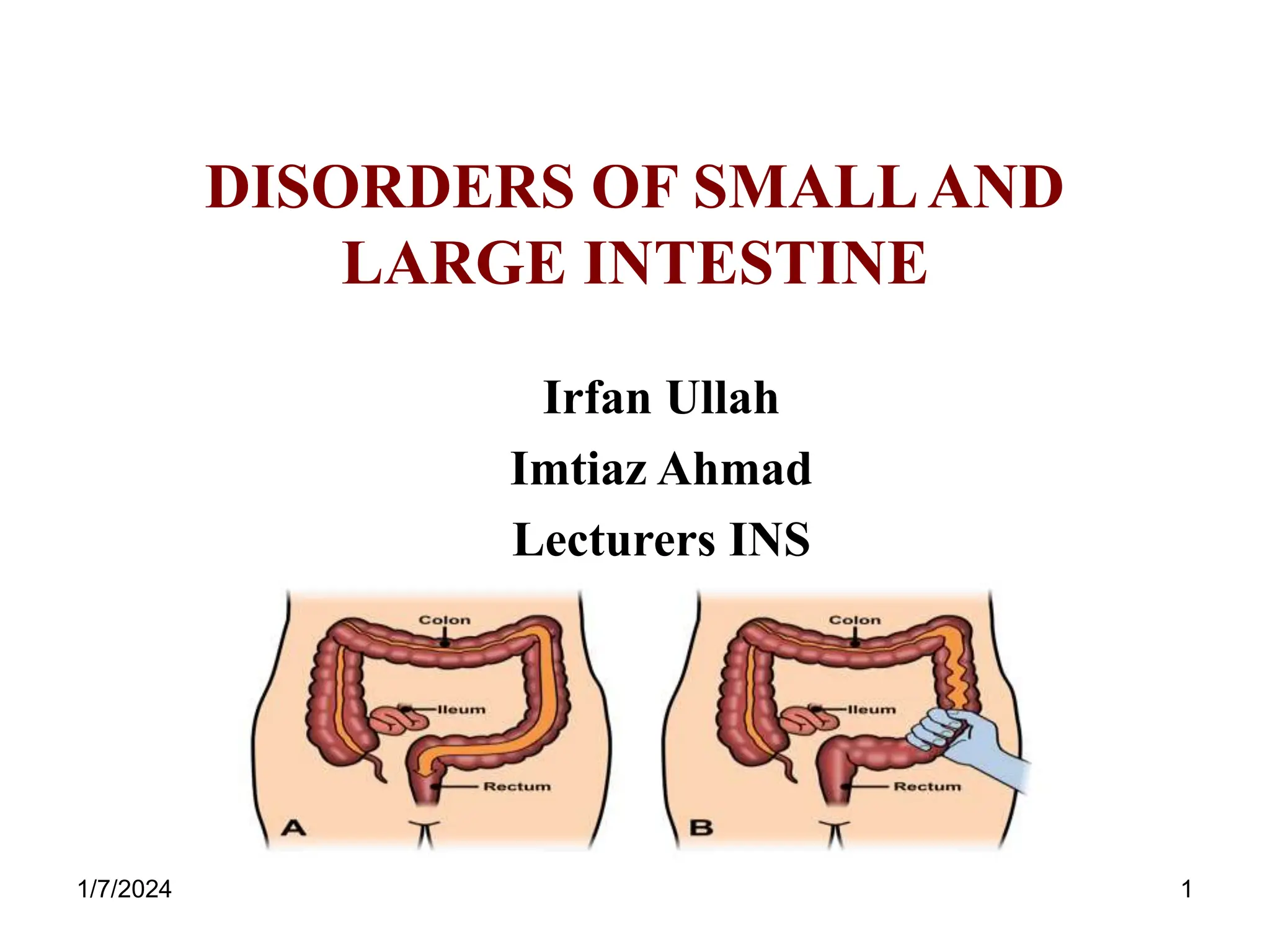 Lec # 5 Disorders of small & large Intestine.ppt