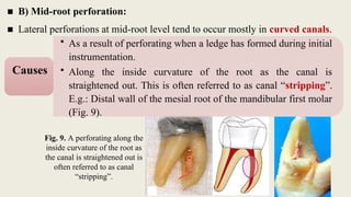■ B) Mid-root perforation:
■ Lateral perforations at mid-root level tend to occur mostly in curved canals.
Fig. 9. A perforating along the
inside curvature of the root as
the canal is straightened out is
often referred to as canal
“stripping”.
• As a result of perforating when a ledge has formed during initial
instrumentation.
• Along the inside curvature of the root as the canal is
straightened out. This is often referred to as canal “stripping”.
E.g.: Distal wall of the mesial root of the mandibular first molar
(Fig. 9).
Causes
 