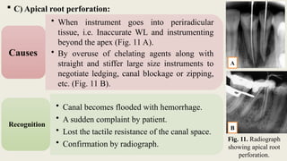  C) Apical root perforation:
• When instrument goes into periradicular
tissue, i.e. Inaccurate WL and instrumenting
beyond the apex (Fig. 11 A).
• By overuse of chelating agents along with
straight and stiffer large size instruments to
negotiate ledging, canal blockage or zipping,
etc. (Fig. 11 B).
Causes
• Canal becomes flooded with hemorrhage.
• A sudden complaint by patient.
• Lost the tactile resistance of the canal space.
• Confirmation by radiograph.
Recognition
Fig. 11. Radiograph
showing apical root
perforation.
A
B
 