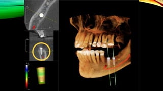 Lec 5 implant | PPTX