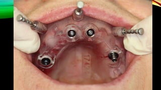 Lec 5 implant | PPTX