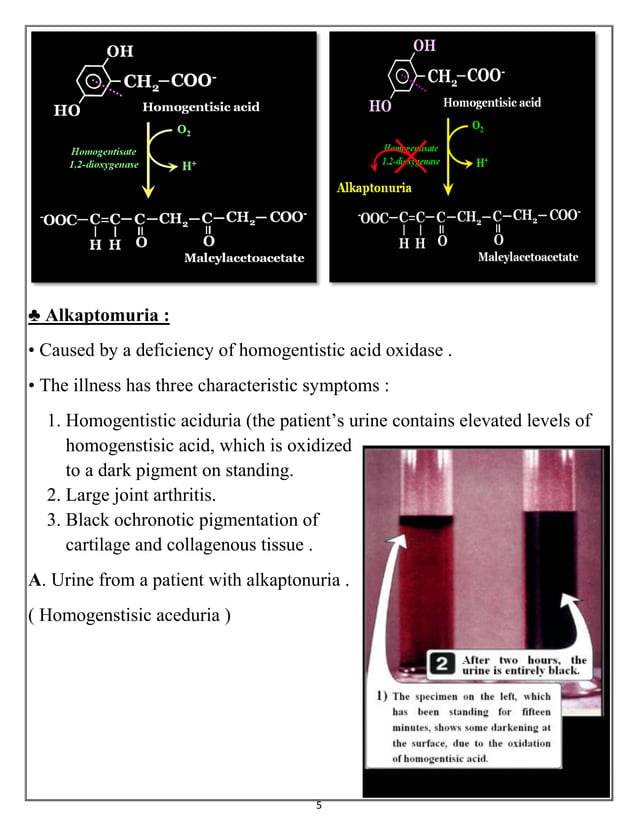 PhenylKetonuria & Alkaptomuria & Albinism & Cystinuria & Maple Syrup