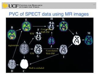 PVC of SPECT data using MR images
100
WM
GM
Skull is excluded
registration
Convolution
With PSF
Convolution
With PSF
 