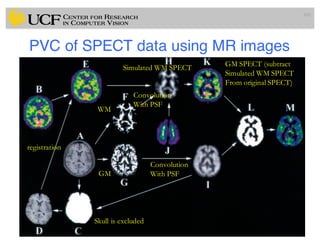 PVC of SPECT data using MR images
101
WM
GM
Skull is excluded
registration
Convolution
With PSF
Convolution
With PSF
Simulated WM SPECT GM SPECT (subtract
Simulated WM SPECT
From original SPECT)
 