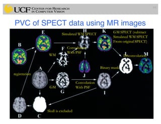 PVC of SPECT data using MR images
102
WM
GM
Skull is excluded
registration
Convolution
With PSF
Convolution
With PSF
Simulated WM SPECT GM SPECT (subtract
Simulated WM SPECT
From original SPECT)
Deconvolution
Binary mask
 