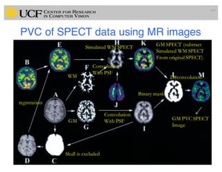 PVC of SPECT data using MR images
103
WM
GM
Skull is excluded
registration
Convolution
With PSF
Convolution
With PSF
Simulated WM SPECT GM SPECT (subtract
Simulated WM SPECT
From original SPECT)
Deconvolution
GM PVC SPECT
Image
Binary mask
 