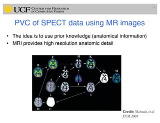 PVC of SPECT data using MR images
• The idea is to use prior knowledge (anatomical information)
• MRI provides high resolution anatomic detail
94
Credit: Matsuda, et al.
JNM 2003
 