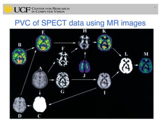 PVC of SPECT data using MR images
95
 